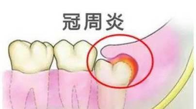 智齿长得正常，不需要拔除的相关知识（智齿的生长过程及当不需要拔除时的注意事项）